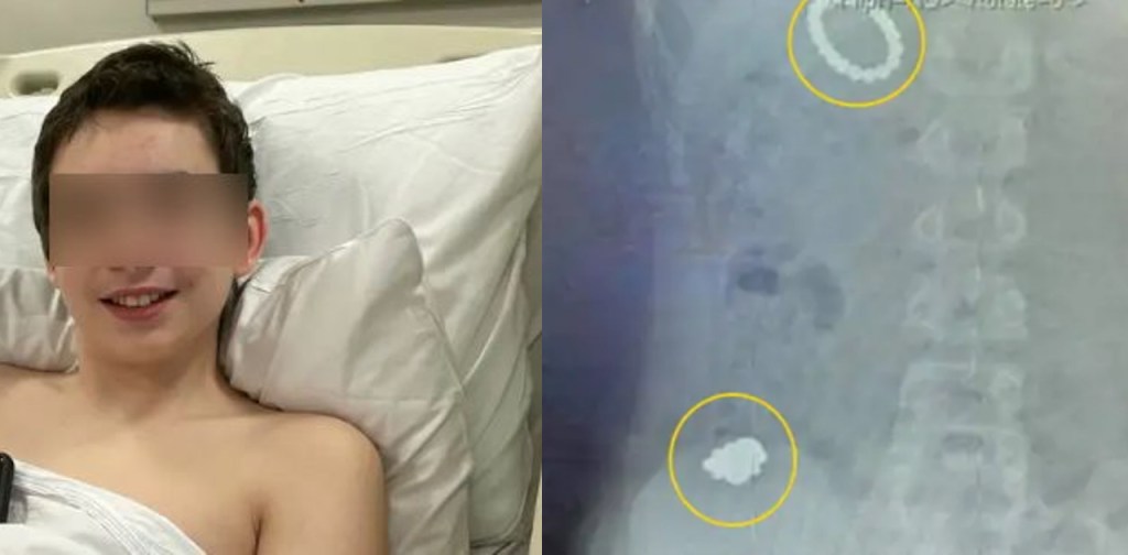 bambino ingoia magneti