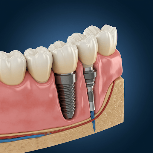 implantologia-dentale-blogsicilia