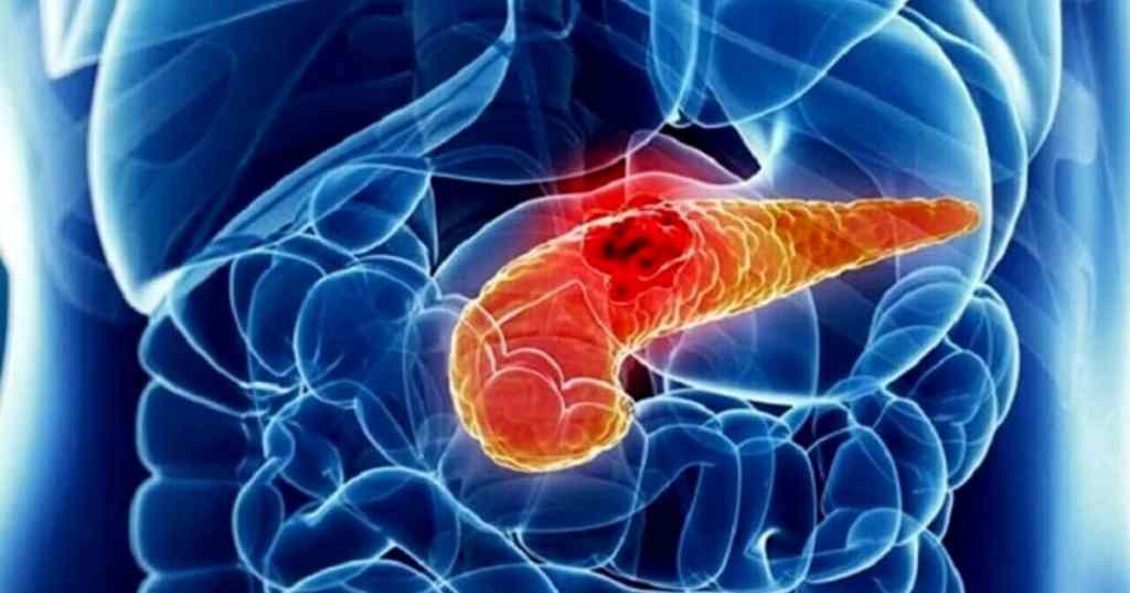 Tumore al pancreas