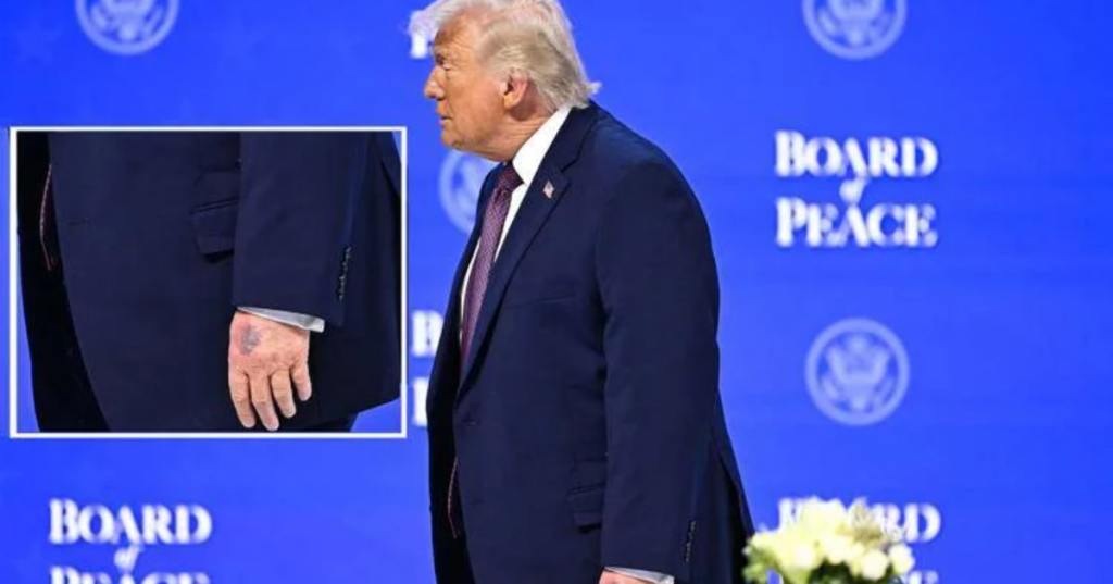 Donald Trump e il livido