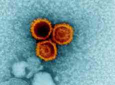 Sclerosi multipla: scoperte le cause della malattia