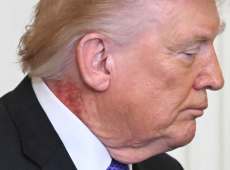 Trump con un segno rosso sul collo, le spiegazioni del medico della Casa Bianca