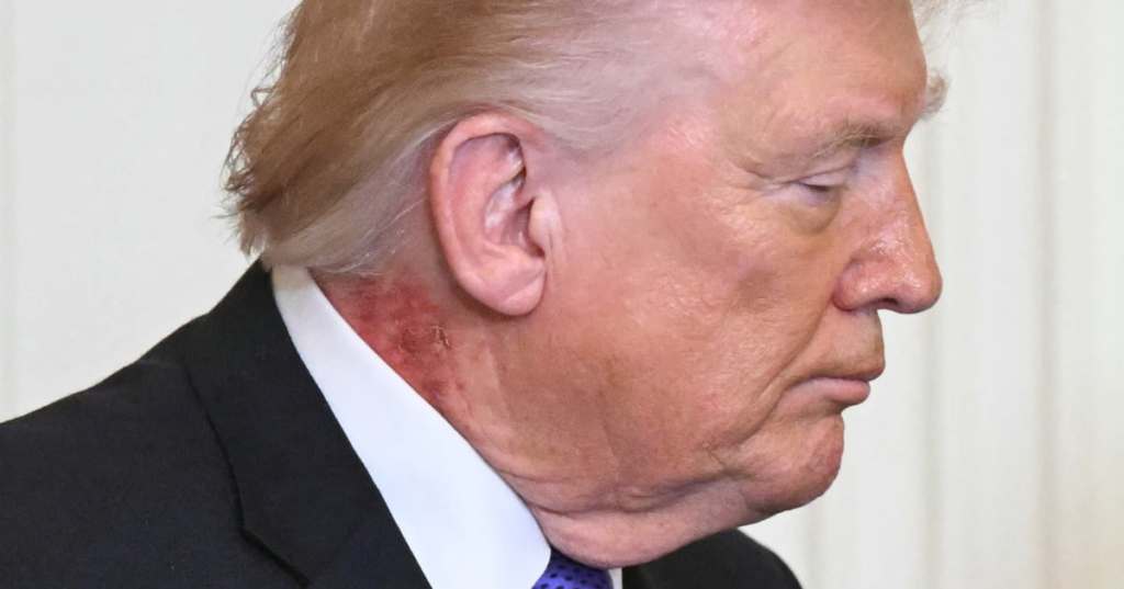 Donald Trump e la macchia rossa sul collo