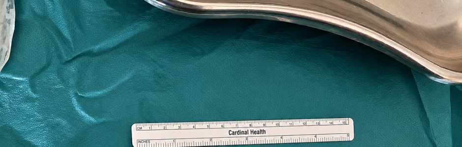 La leva del freno persa a 10 anni era nella sua schiena: la scopre una radiografia tre anni dopo